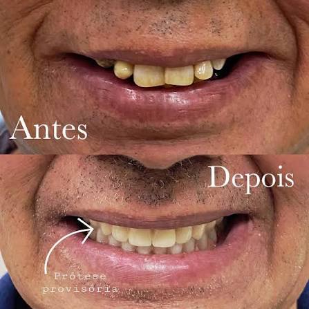 Reabilitação com prótese provisória imediata
